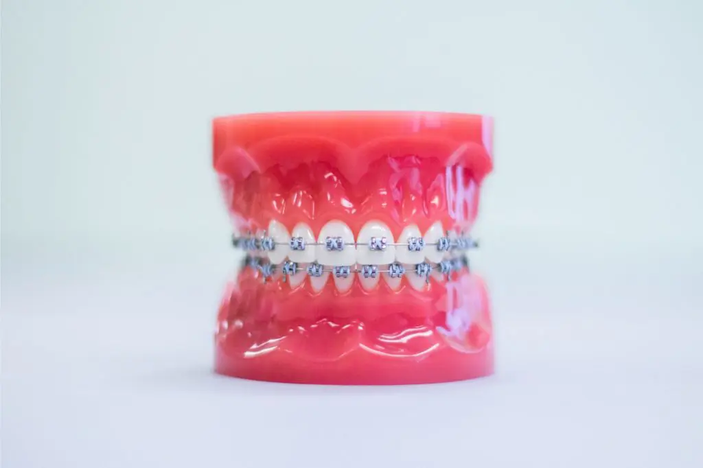 braces everett wa
