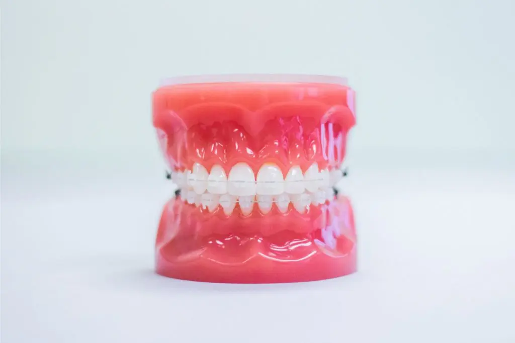 braces everett wa