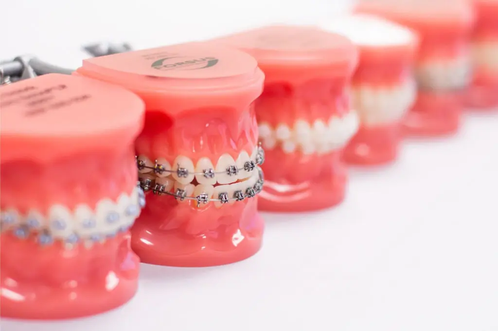 braces everett wa
