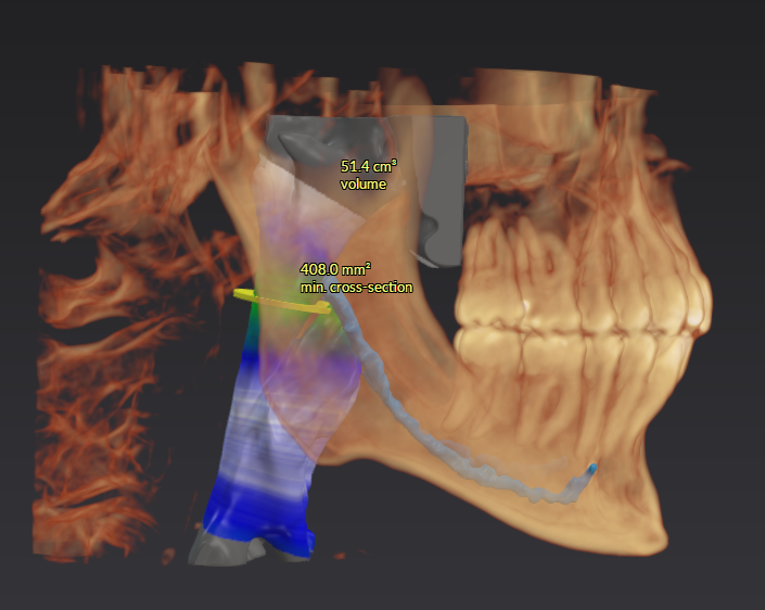 pediatric-airway-CBCT evaluation-everett