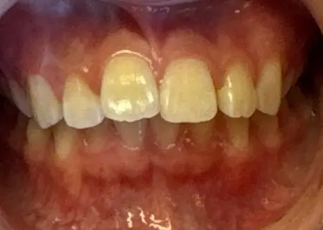 Frontal view of a patient's teeth showing a Class 2 deep bite before orthodontic treatment at Align Choice Orthodontics in Everett, WA.