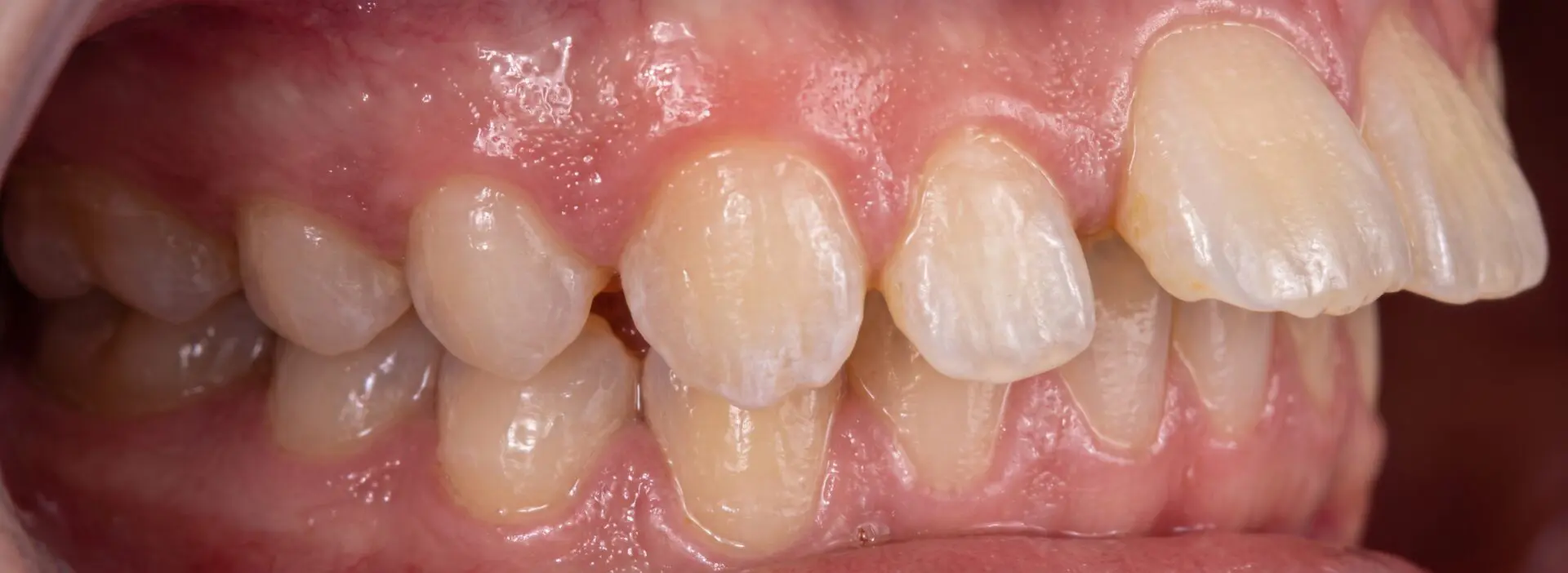 Right side view of a patient's teeth showing a Class 2 overjet before orthodontic treatment at Align Choice Orthodontics in Everett, WA.