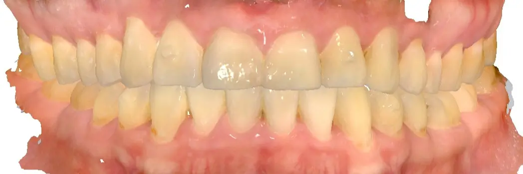 After Treatment