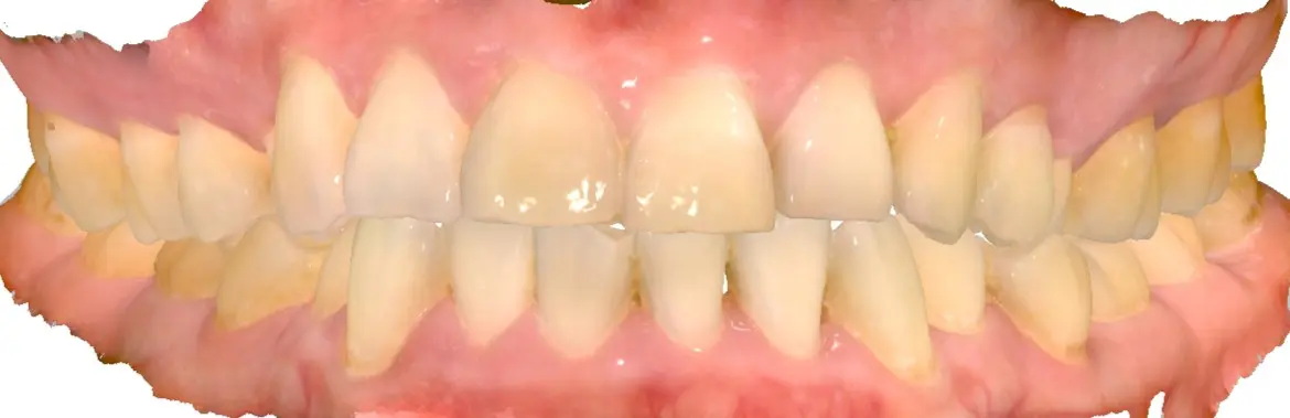 Before Treatment